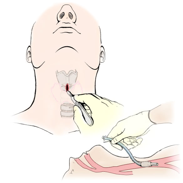 A medical illustration showing where to make the incision and how to insert the endotracheal tube when performing an emergency cricothyroidotomy procedure. Used as an instructional graphic aid in an interactive electronic combat training course for medics in the U.S. Marine Corps.